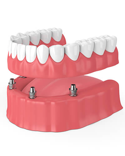 Dental Implants Bellevue, WA - DrDaniel Varadi